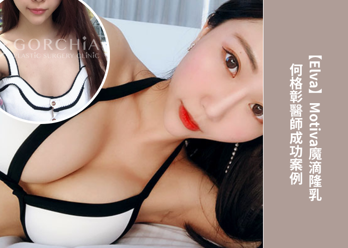 台中隆乳推薦丨格嘉內視鏡隆乳案例03